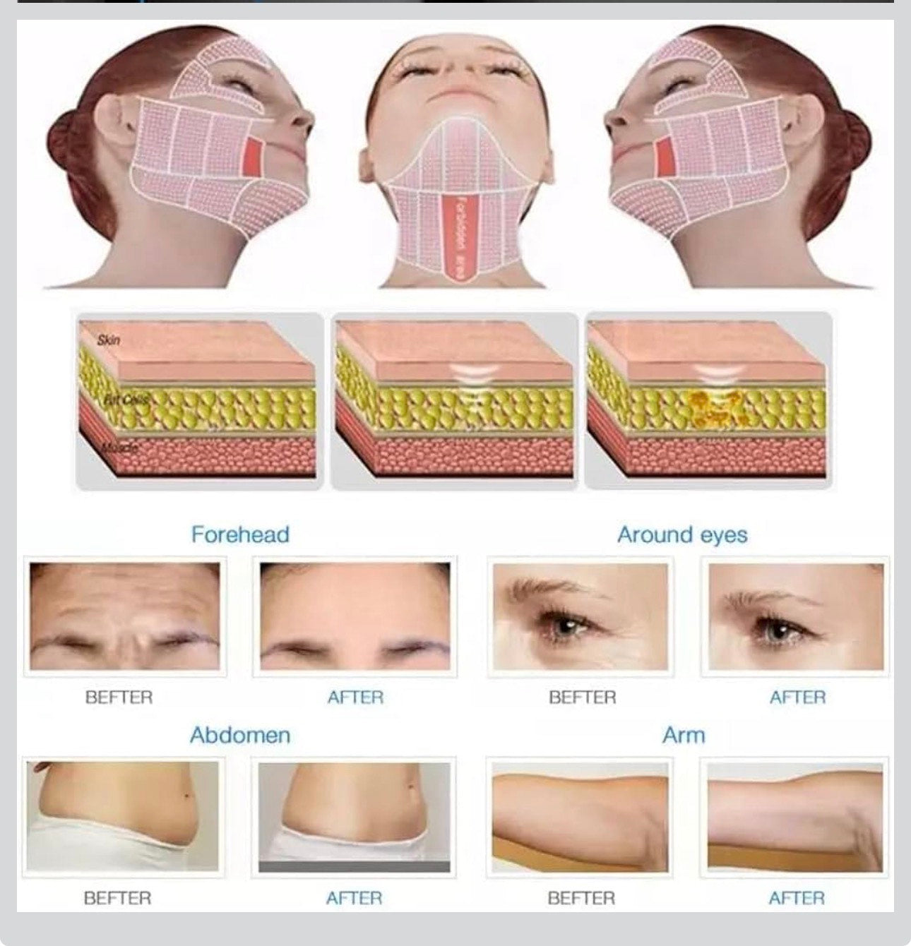 4D HIFU High Intensity Fractional Microneedle